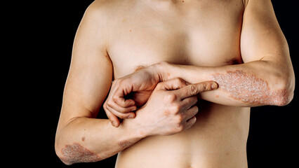 Fototapeta premium Acute psoriasis on the elbows is an autoimmune incurable dermatological skin disease. A large red, inflamed, flaky rash on the elbows. Joints affected by psoriatic arthritis