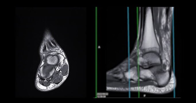 mri ankle joint coronal and sagittal T2 for diagnosis tendon of ankle joint injury.