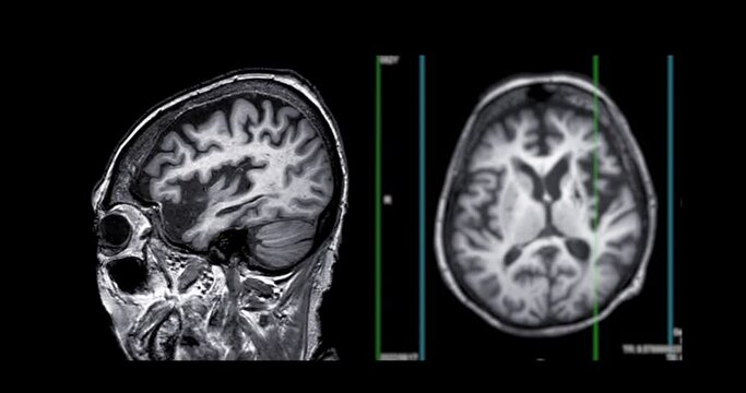 MRI of the brain compare sagittal and axial plane  for diagnosis stroke diseases.