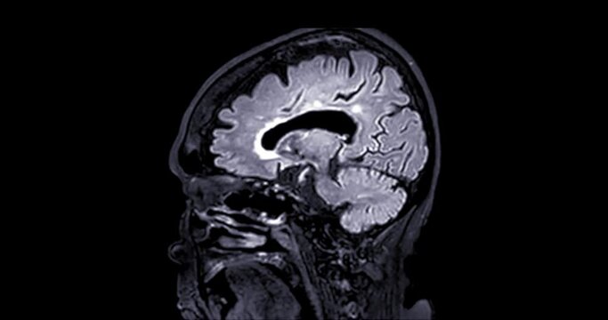 MRI of the brain  sagittal plane  for diagnosis stroke diseases.