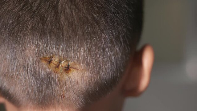 The lacerated sutured wound of kid back head which suture by nylon suture about 3 stitches at the emergency room of the hospital, Medical care of the surgery lesion on the head, children of Accident