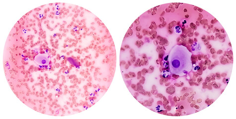 College of two microscopic image showing radiation induced changes. vault smear.