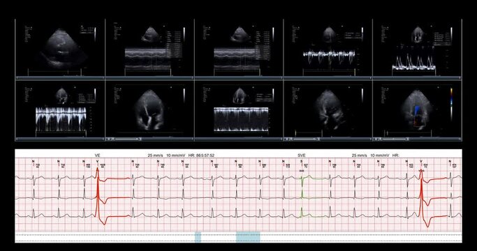 Display screen of view echo heart transthoracic cardiogram ultrasound screen is examining heart on digital tablet the equipment in a clinica