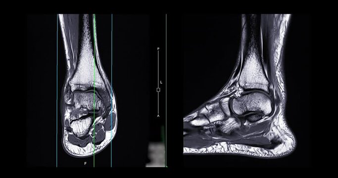 mri ankle joint coronal and sagittal T2 for diagnosis tendon of ankle joint injury.
