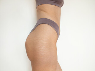stretch marks on female hips
Female hips with a stretch marks
woman body  - obrazy, fototapety, plakaty