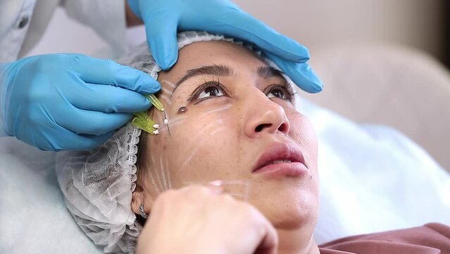 Thread lifting is a cosmetological procedure for face rejuvenation. The beautician implants cosmetic threads under the skin to relieve facial ptosis.