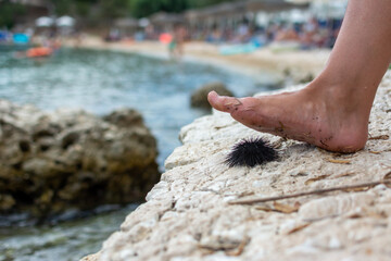 the leg stops sea ​​urchin on the beach
