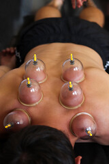 Cup massage. Massage vacuum banks. Close-up of man lying with cups on his back in spa salon. Vacuum...