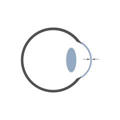 Grafische Darstellung einer Pachymetriemessung