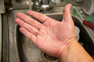 Wrinkled skin of the hands because of long time in water.