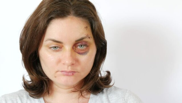 Large real bruise hematoma under the eye of a young woman, purple bruise. Broken lip and forehead wound. terrified face of domestic violence victim close-up white background.