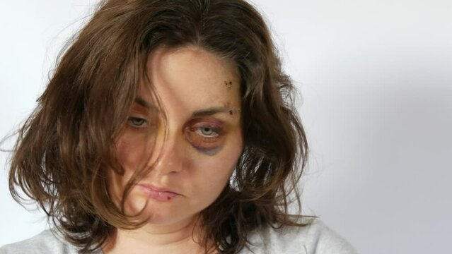 Large real bruise hematoma under eye of young woman, purple bruise. Broken lip and forehead wound. terrified face of domestic violence victim. Woman touching her tousled hair