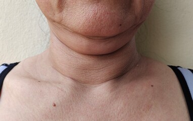 Portrait showing the flabbiness adipose sagging under the neck, the mole and Dullness on the body, problem wrinkle and cellulite under the chin of the woman, concept health care.