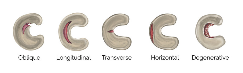 Types of meniscus injury tear - obrazy, fototapety, plakaty