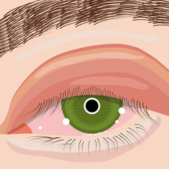 eyelid infection vector illustration