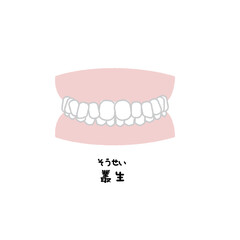 叢生　歯並び　イラスト