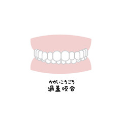過蓋咬合　歯並び　イラスト