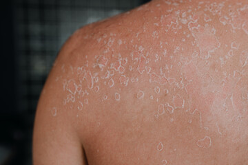 Dermatological conditions of peeling skin on man's back and shoulders, peeling skin and skin care concept. Close up
