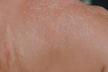 Fototapeta premium Skin texture background with flaking cell scales after sunburn and allergy on human body