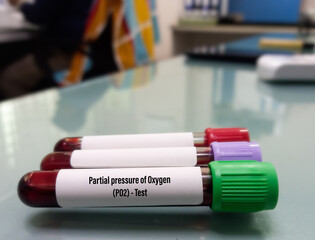 Blood sample for Partial pressure of oxygen(PO2) test. Breathing disease.