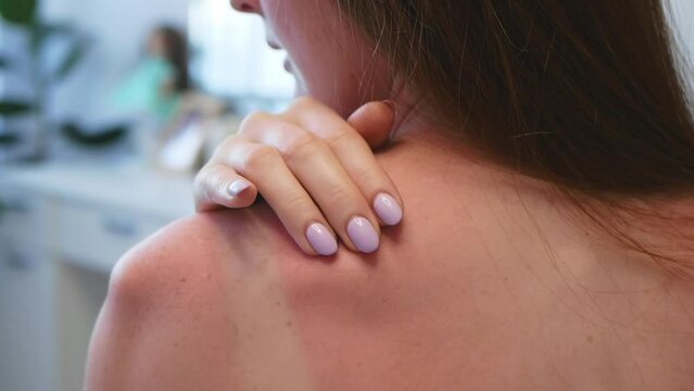 Red hair woman strokes and scratches sunburn skin on back and shoulders. Close-up view of back and shoulders with sunburn marks. Woman with reddened itchy skin. Concept of sunbathe without sunscreen.