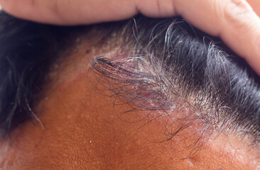 skin disease at the head, Dandruff is a common condition that causes the skin on the scalp to flake
