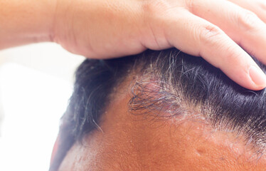 Naklejka premium skin disease at the head, Dandruff is a common condition that causes the skin on the scalp to flake