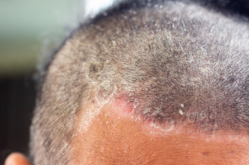 skin disease at the head, Dandruff is a common condition that causes the skin on the scalp to flake