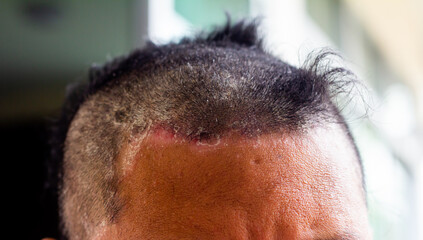 skin disease at the head, Dandruff is a common condition that causes the skin on the scalp to flake