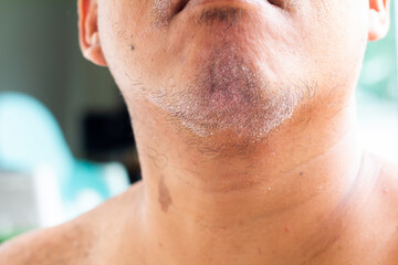 skin disease at the chin, Dandruff is a common condition that causes the skin on the chin to flake