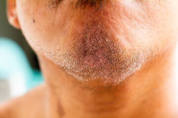 skin disease at the chin, Dandruff is a common condition that causes the skin on the chin to flake
