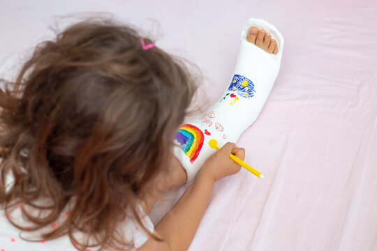 A unrecognizable little girl with a broken leg at home on the bed draws with felt-tip pens on an orthopedic cast . How to have fun with a broken leg. Broken leg in a cast of an young child. 