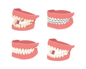 Human Jaw set isolated on white background. Opened, closed, jaws and jaws with braces. Dental model of human jaws. Healthy oral hygiene. Trendy graphic for stomatology, dentist. Vector illustration