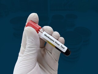Biochemist of Scientist holds blood sample for Monkeypox virus test. A double stranded DNA virus and member of Poxviridae family.