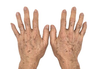 Age spots on hands of Asian man. They are brown, gray, or black spots and also called liver spots,...