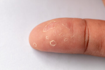 Fototapeta premium Pattern of Atopic eczema and fungal diseases on the human body.
