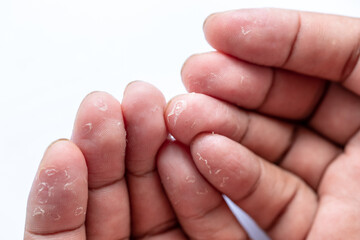 Pattern of Atopic eczema and fungal diseases on the human body.