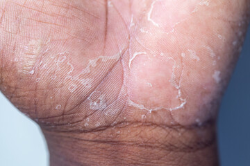 Fototapeta premium Pattern of Atopic eczema and fungal diseases on the human body.