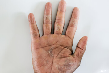 Pattern of Atopic eczema and fungal diseases on the human body.