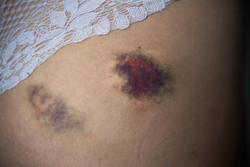 Large bruise on a woman's bum. Close up of a hematoma on buttock after fall. A minor injury after sport activity appearing as a swollen area of discolored skin on the body