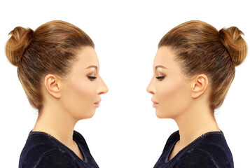 face beauty, nose and chin correction, rhinoplasty, genioplasty,Chin augmentation