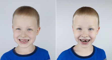 Before and after. Falling out milk tooth. Blond boy in photo has a loose milk tooth, and in other image it has already fallen out. An empty space in place of front teeth. Loss of milk teeth