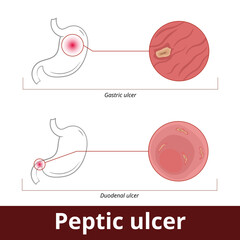 Peptic ulcer. Visualization of stomach disease including gastric ulcer and duodenal ulcer. Open sores develop on the inside lining of the stomach or upper portion of small intestine.