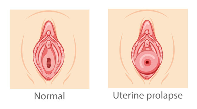 Uterine prolapse. (left) Lateral view of pelvis showing normal