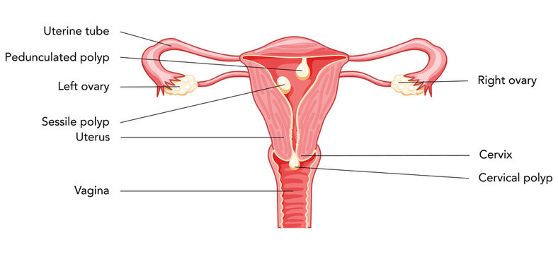 Polyp in the uterus with inscriptions diagram Female reproductive system in cross sections. Front view in a cut. Human anatomy diseases internal organs location scheme, cervix, ovary flat style icon