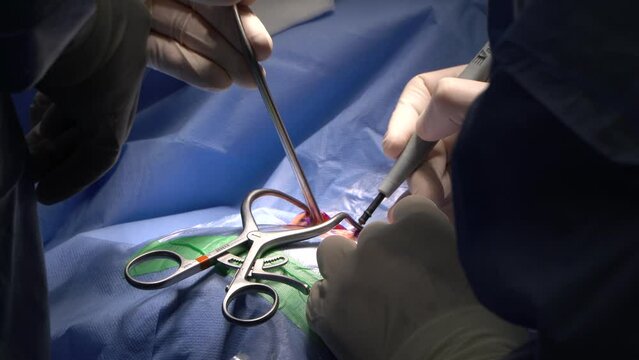 Neurosurgery or neurological surgery, known in common parlance as brain surgery, is the medical specialty concerned with the surgical treatment