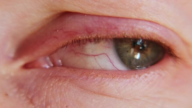 Extreme close-up inflamed vessels human eye. Blinking tired sick eye, macro. Conjunctivitis insomnia. Woman's eyeball with red capillaries.