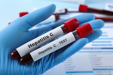 Naklejka premium Scientist holding tubes with blood samples for hepatitis virus test near laboratory form, closeup