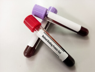 Blood sample for Retinol Binding Protein testing which is used to assess renal tubular injury or dysfunction.