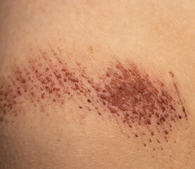 scratches on the skin of the leg as a background
